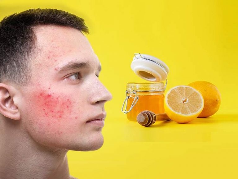 Diy Honey And Lemon Mask For Acne Scars 365 Gorgeous